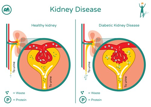 life expectancy with diabetes and kidney failure