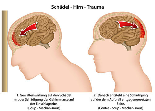 Garagentor Auf Den Kopf Gefallen Gehirnerschütterung